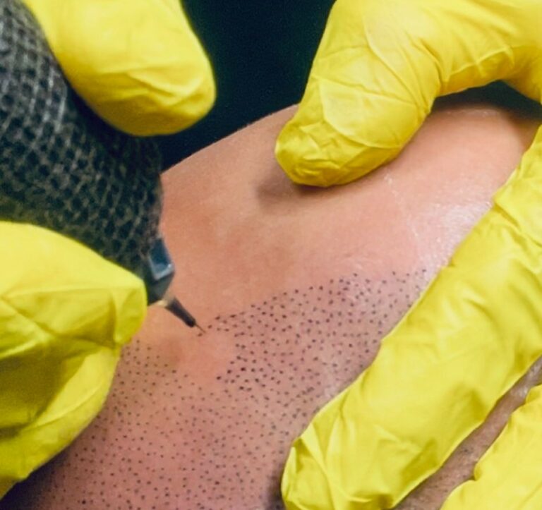 Tricopigmentation vs Greffe Capillaire : Quelle solution choisir ?