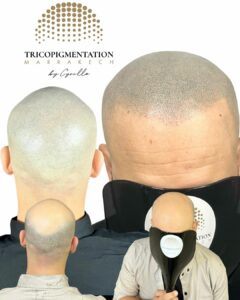 Tricopigmentation Homme