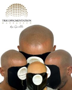 Tricopigmentation Homme